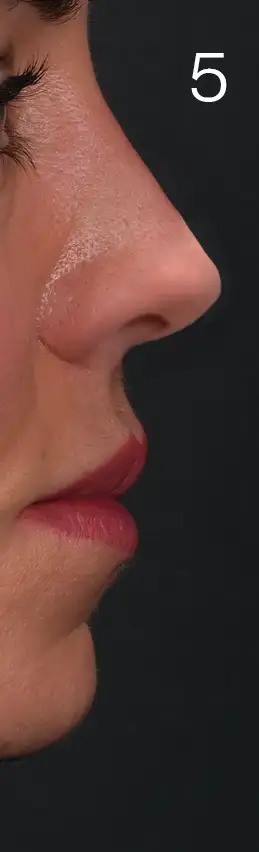 erhan-nose-mid-5tip.webp