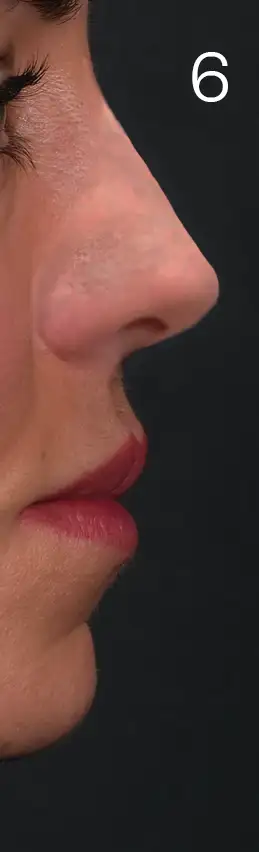 erhan-nose-mid-6me1.webp