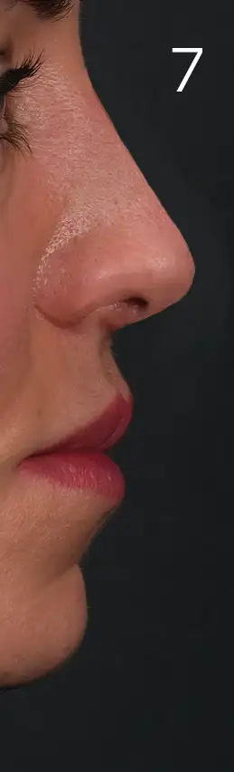 erhan-nose-mid-7me2.webp
