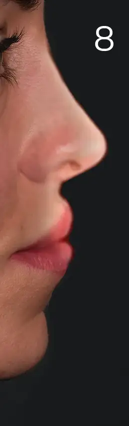 erhan-nose-mid-8budun.webp