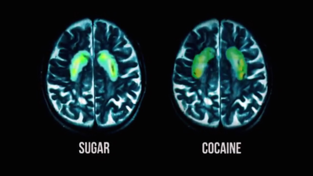 fed-up-sugar-cocaine-brain-scan-6201.jpg
