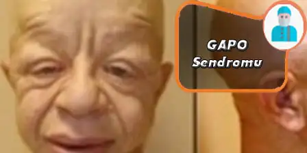 GAPO-Sendromu.webp