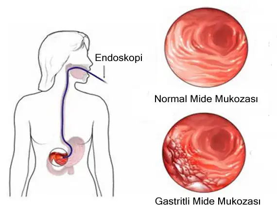 gastrit (1).webp