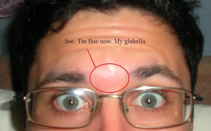 glabella.webp