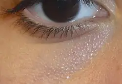 goz_altı1.webp