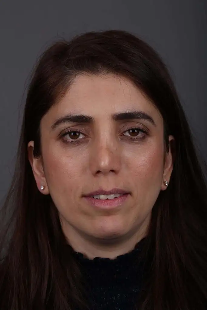 Gülşah AKYOL Preop 26012019 (1).webp