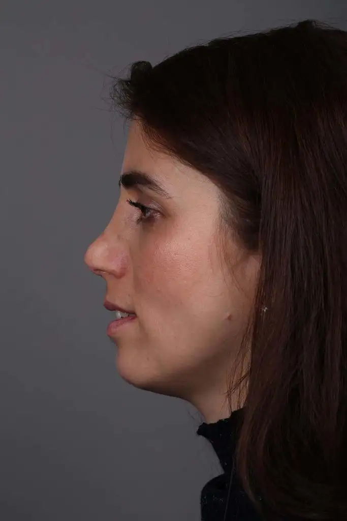Gülşah AKYOL Preop 26012019 (10).webp