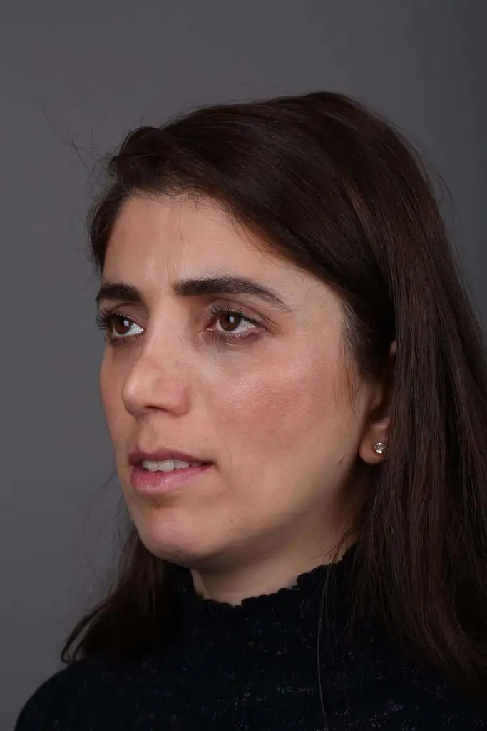Gülşah AKYOL Preop 26012019 (11).webp