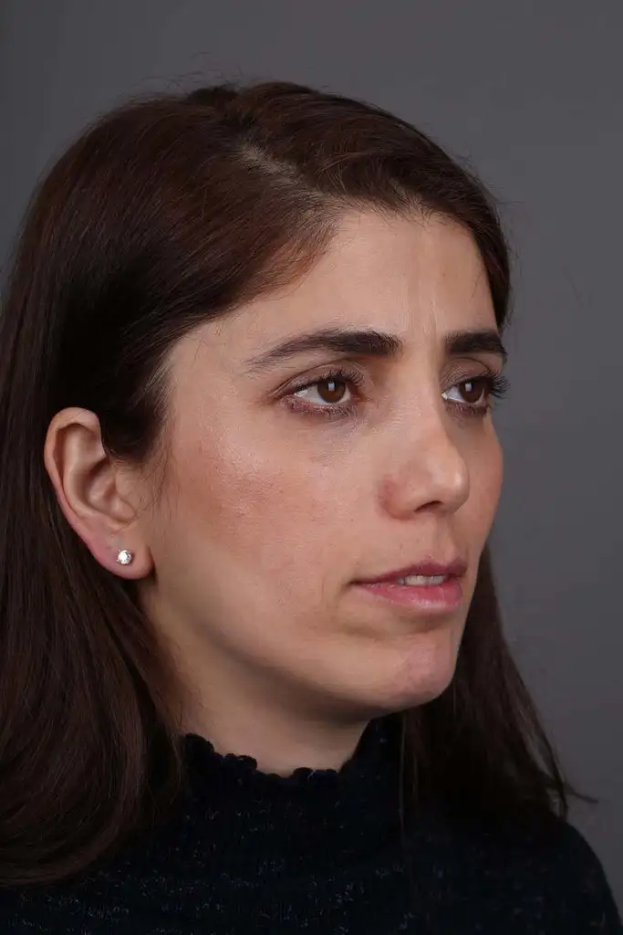 Gülşah AKYOL Preop 26012019 (12).webp