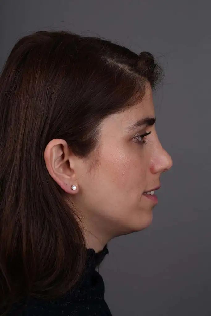 Gülşah AKYOL Preop 26012019 (13).webp