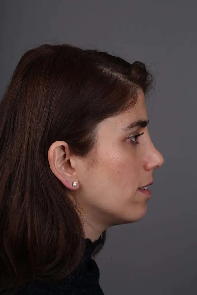 Gülşah AKYOL Preop 26012019 (14).webp