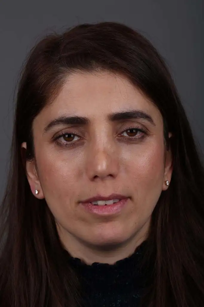 Gülşah AKYOL Preop 26012019 (3).webp