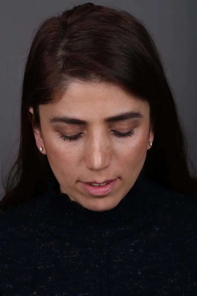 Gülşah AKYOL Preop 26012019 (4).webp