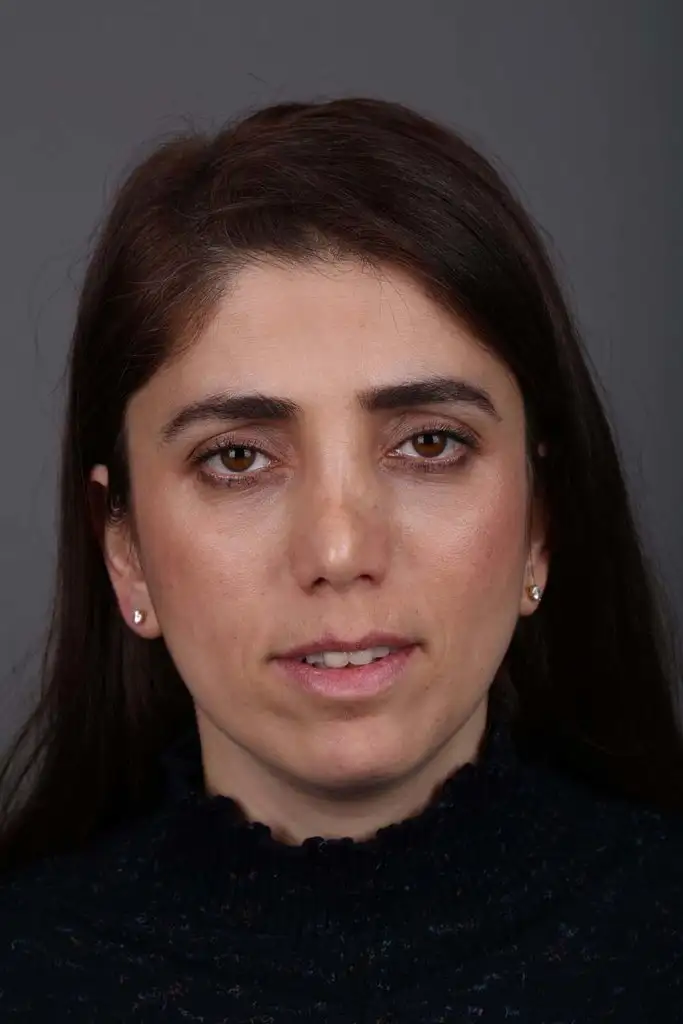 Gülşah AKYOL Preop 26012019 (5).webp