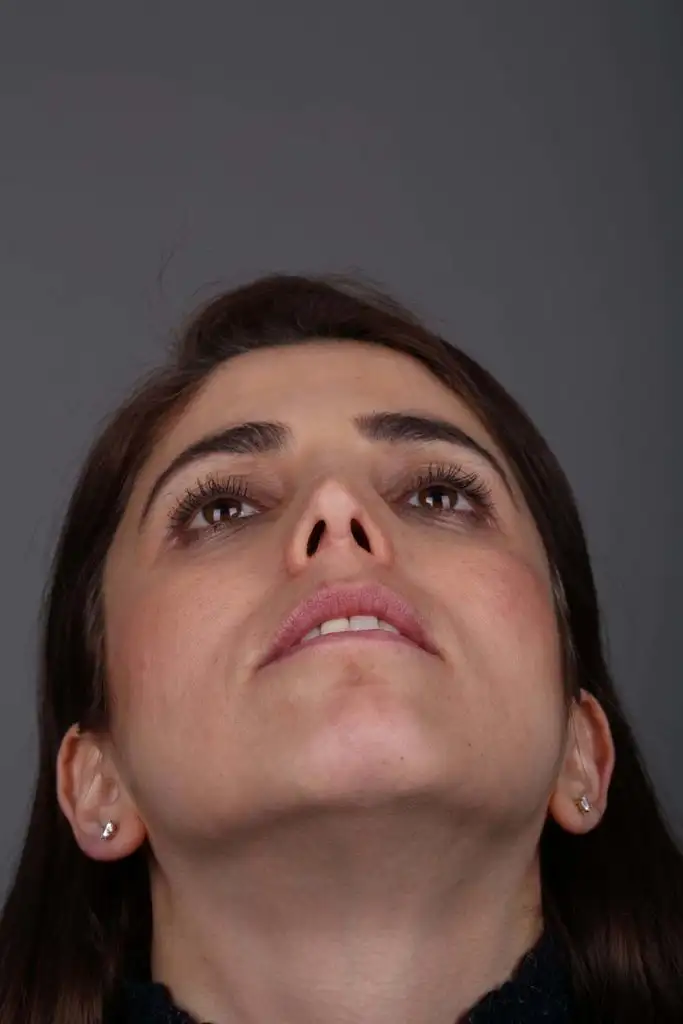 Gülşah AKYOL Preop 26012019 (7).webp