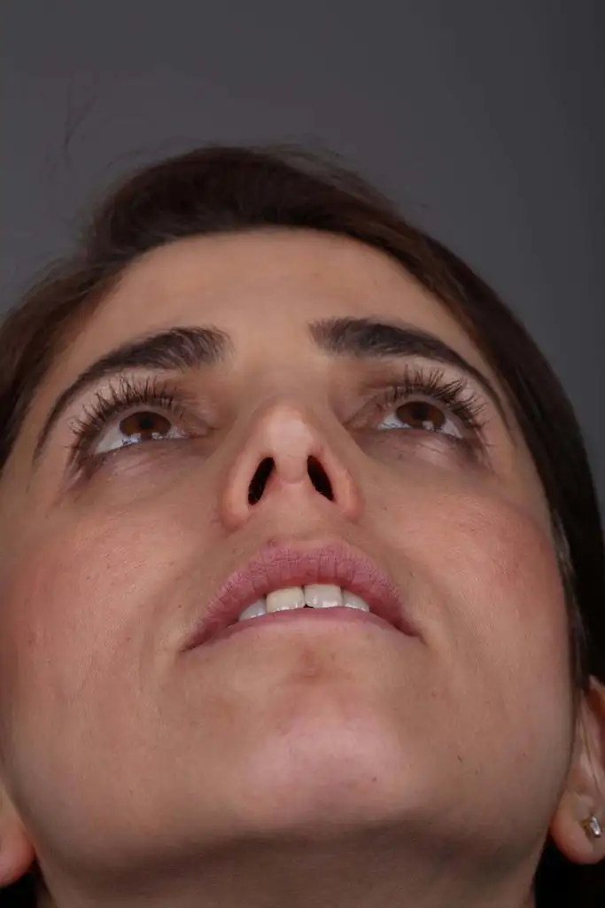 Gülşah AKYOL Preop 26012019 (8).webp