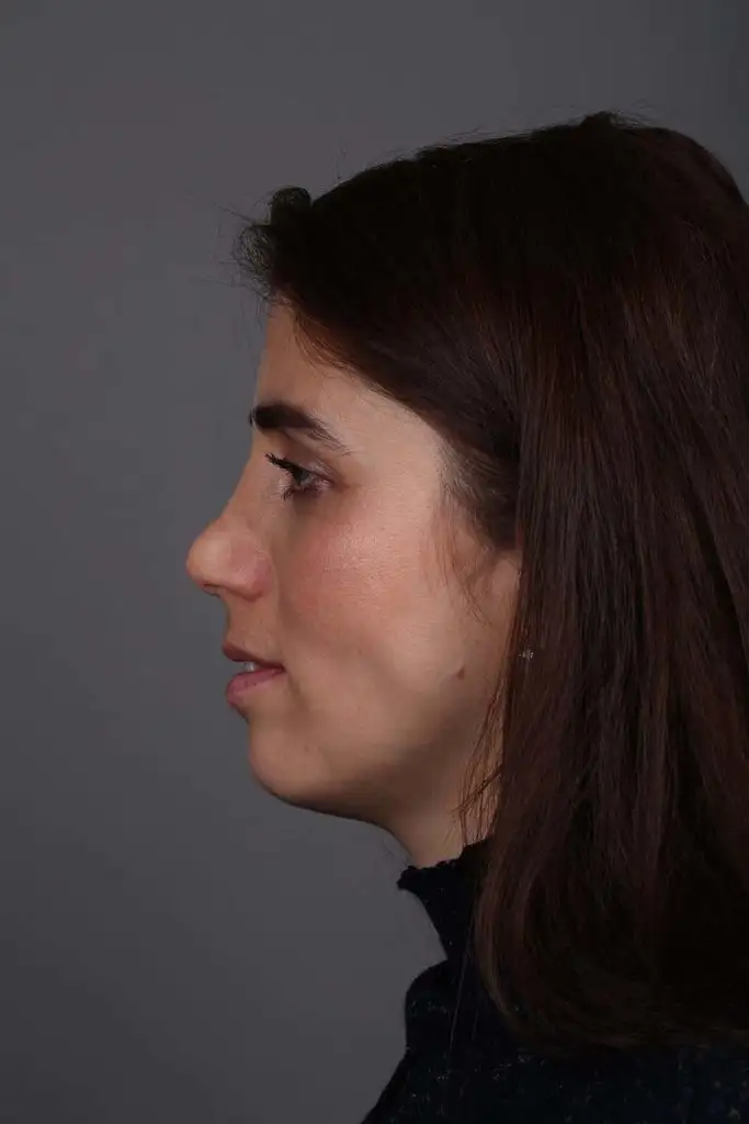 Gülşah AKYOL Preop 26012019 (9).webp