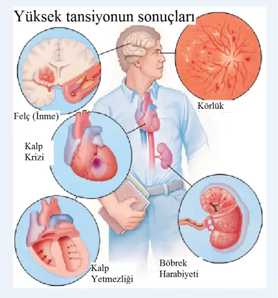 böbrek hipertansiyonunun nedenleri