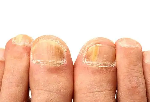 how-long-is-ringworm-contagious-500x339.webp