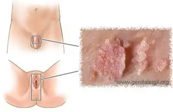 hpv_genital_sigil_kondilom.webp