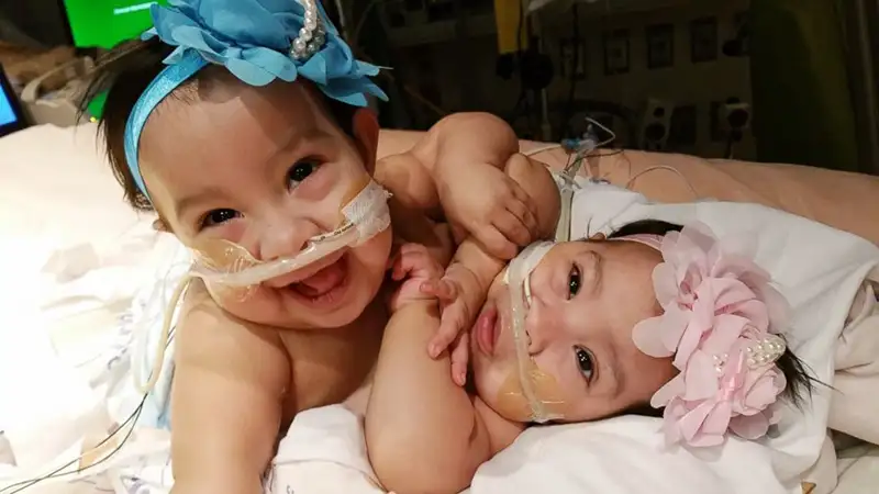 ht_conjoined_twins_mata_2_jc_150223_16x9_992.webp