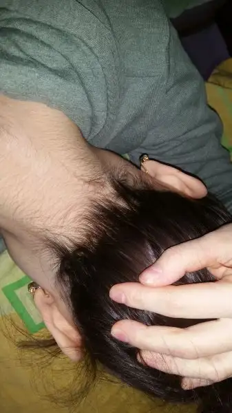 igneli epilasyon igneli epilasyon yaptiracaklar mutlaka okuyun kadinlar kulubu