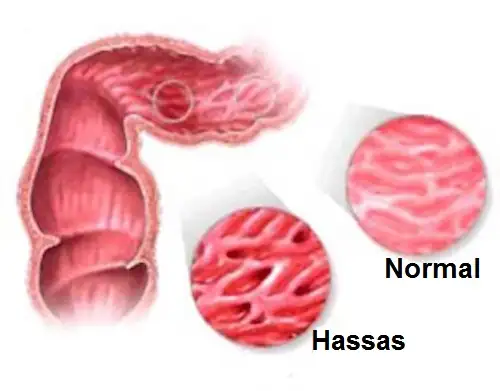 Irritablebowel1.webp