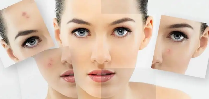 ışık-peeling.webp