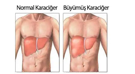 karaciger-buyumesi.webp