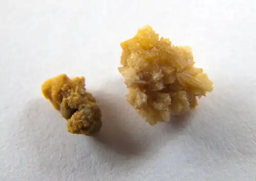 Kidney-stones.webp