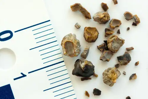 Kidney-stones2.webp