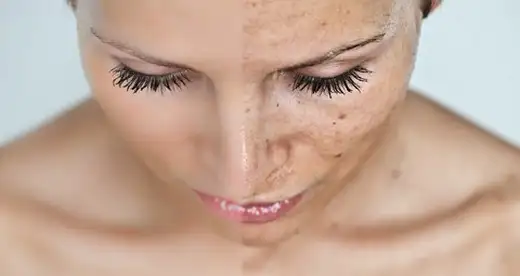 leke-tedavisi.webp
