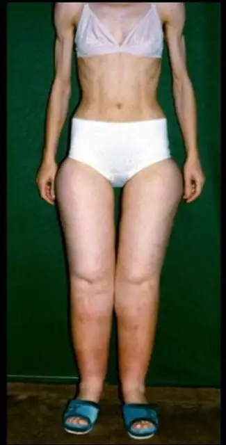 lipedemafat.webp