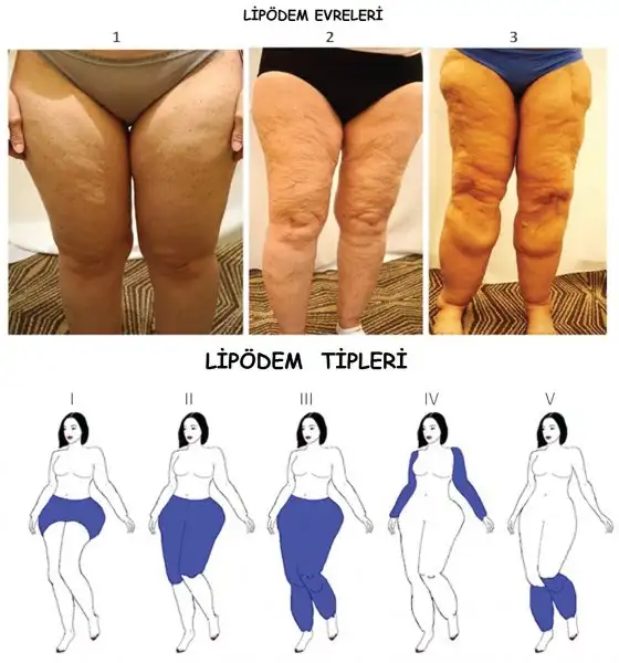 lipödem evre ve tipleri.webp