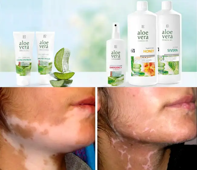 LR-Vitiligo-Tedavisi-3.webp