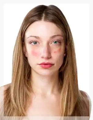 lupus_.webp