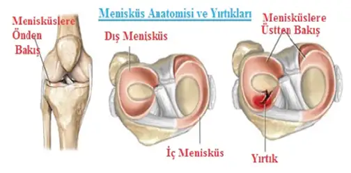 Menisküs-Yırtığı.webp