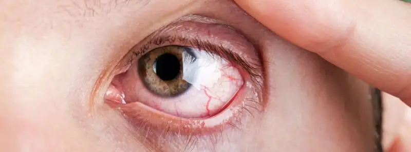 original_Dry_Eyes.webp