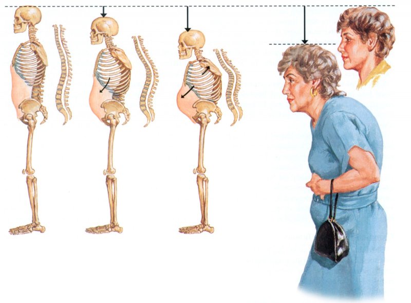 Osteoporoz.jpg