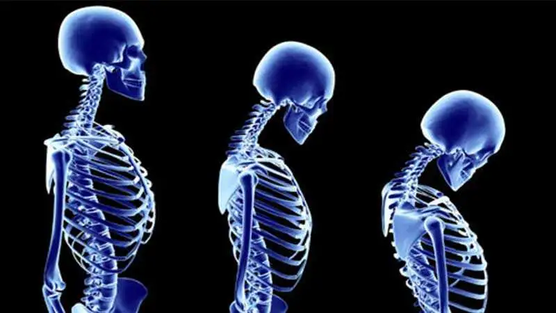 Osteoporoz-nedir-engin-çakar.webp