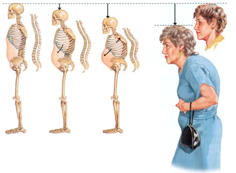 Osteoporoz.webp