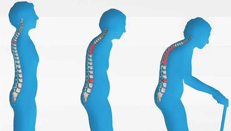osteoporoz2.webp