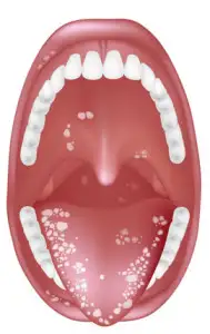 pamukcuk-belirtileri-189x300.webp