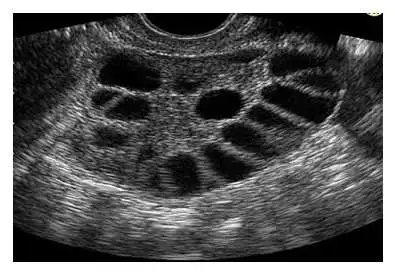 pcos.webp