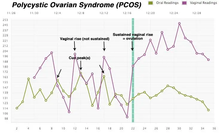 PCOS.webp