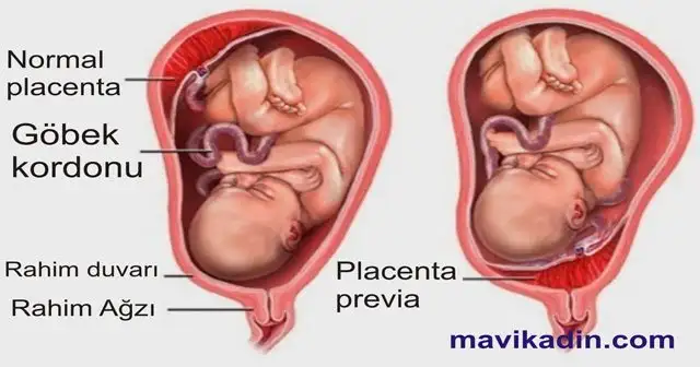 plasenta-previa-totalis-marginalis-marjinal-nedir-dogum-yapanlar-var-mi-1521909916.webp