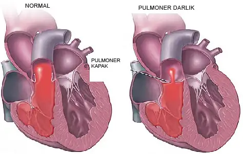 pulmoner-darlik.webp