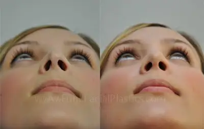 Revision nose job houston.webp