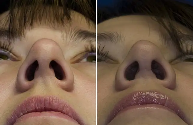 revision-rhinoplasty-patient-2-base.webp
