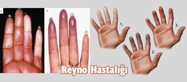 reyno-hastaligi.webp